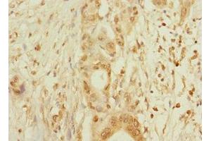 Immunohistochemistry of paraffin-embedded human pancreatic cancer using ABIN7160425 at dilution of 1:100 (MPZL2 anticorps  (AA 30-140))