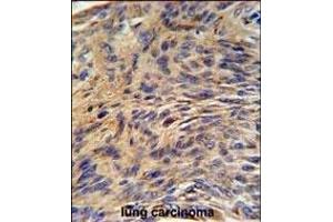 HS Antibody (Center) (ABIN651232 and ABIN2840144) IHC analysis in formalin fixed and paraffin embedded human lung carcinoma followed by peroxidase conjugation of the secondary antibody and DAB staining. (GRP78 anticorps  (AA 261-289))