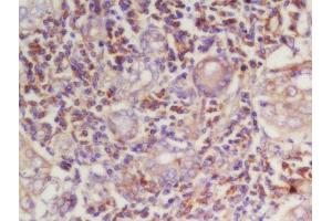 Formalin-fixed and paraffin embedded human laryngeal carcinoma labeled with Rabbit Anti-Cyclin E Polyclonal Antibody, Unconjugated (ABIN670311) at 1:200 followed by conjugation to the secondary antibody and DAB staining