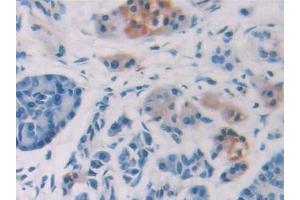 Detection of IL15 in Human Pancreatic cancer Tissue using Polyclonal Antibody to Interleukin 15 (IL15)