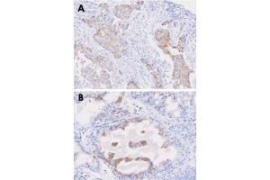 Paraffin embedded sections of human breast cancer (A) and prostate hyperplasia tissue (B) were incubated with STEAP1 monoclonal antibody, clone J2D2  (1 : 50) for 2 hours at room temperature.