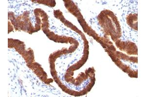 Formalin-fixed, paraffin-embedded human Ovarian Carcinoma stained with Cytokeratin 19 Mouse Monoclonal Antibody (KRT19/799).