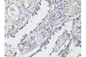 Immunohistochemistry of paraffin-embedded human lung cancer using NTRK2 antibody (ABIN6290695) at dilution of 1:200 (40x lens).
