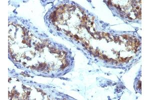 Formalin-fixed, paraffin-embedded human Testicular Carcinoma stained with Alkaline Phosphatase Mouse Monoclonal Antibody (ALPL/597).