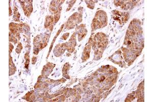 IHC-P Image TBCC antibody [N1C3] detects TBCC protein at cytosol on human breast carcinoma by immunohistochemical analysis.