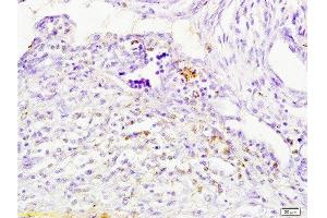 Formalin-fixed and paraffin embedded human breast carcinoma tissue labeled with Anti-Cathepsin H Polyclonal Antibody, Unconjugated  at 1:200 followed by conjugation to the secondary antibody, (SP-0023), and DAB staining