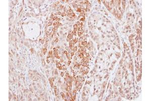 IHC-P Image Immunohistochemical analysis of paraffin-embedded A549 xenograft, using Kininogen 1, antibody at 1:500 dilution.