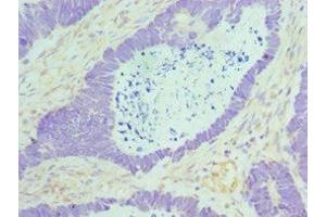 Immunohistochemistry of paraffin-embedded human ovarian cancer using ABIN7160088 at dilution of 1:100 (MAD2L1 anticorps  (AA 1-205))