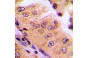 Immunohistochemical analysis of MGCRACGAP staining in human lung cancer formalin fixed paraffin embedded tissue section.