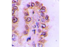 Immunohistochemical analysis of Cytochrome P450 4F2 staining in human liver cancer formalin fixed paraffin embedded tissue section.