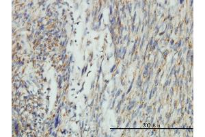 Immunoperoxidase of monoclonal antibody to DNM1L on formalin-fixed paraffin-embedded human leiomyosarcoma tissue.