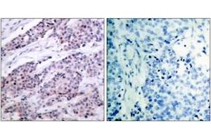 Immunohistochemistry analysis of paraffin-embedded human breast carcinoma tissue, using BCL-2 (Ab-56) Antibody. (Bcl-2 anticorps  (AA 26-75))