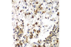 Immunohistochemistry of paraffin-embedded human kidney cancer using SND1 antibody (ABIN5973481) at dilution of 1/100 (40x lens). (SND1 anticorps)