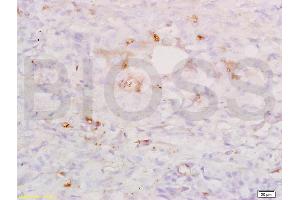 Formalin-fixed and paraffin embedded human lung carcinoma labeled with Anti-SP-D/PSPD Polyclonal Antibody, Unconjugated (ABIN731678) at 1:200, followed by conjugation to the secondary antibody and DAB staining. (SFTPD anticorps  (AA 301-375))