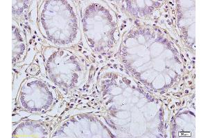 Formalin-fixed and paraffin embedded human colon carcinoma labeled with Anti-FUS Polyclonal Antibody, Unconjugated (ABIN682438) at 1:200 followed by conjugation to the secondary antibody and DAB staining