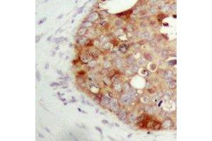 Immunohistochemical analysis of FAP alpha staining in human prostate cancer formalin fixed paraffin embedded tissue section. (FAP anticorps)