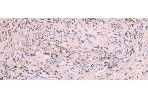 Immunohistochemistry of paraffin-embedded Human cervical cancer tissue using MBTPS2 Polyclonal Antibody at dilution of 1:30(x200) (MBTPS2 anticorps)