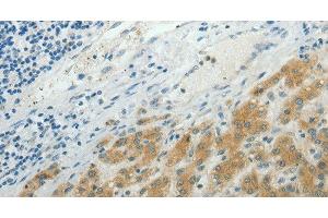 Immunohistochemistry of paraffin-embedded Human liver cancer using NDRG2 Polyclonal Antibody at dilution of 1:50 (NDRG2 anticorps)