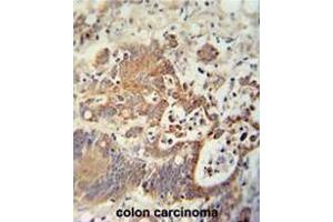 CHCHD2 antibody (Center) immunohistochemistry analysis in formalin fixed and paraffin embedded human colon carcinoma followed by peroxidase conjugation of the secondary antibody and DAB staining. (CHCHD2 anticorps  (Middle Region))
