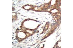 Immunohistochemical analysis of PER2 (pS662) staining in human prostate cancer formalin fixed paraffin embedded tissue section. (PER2 anticorps  (pSer662))