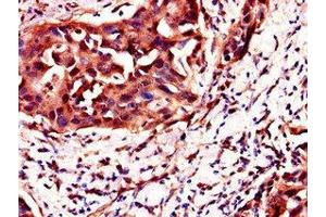 Immunohistochemistry of paraffin-embedded human bladder cancer using ABIN7162131 at dilution of 1:100 (Uncharacterized Protein C4orf26 (ODAPH) (AA 24-130) anticorps)