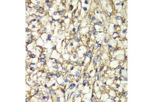 Immunohistochemistry of paraffin-embedded human kidney cancer using PTGES2 antibody (ABIN5974292) at dilution of 1/100 (40x lens). (PTGES2 anticorps)