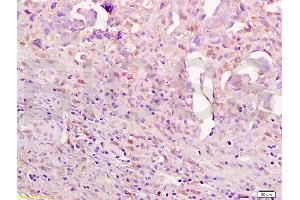 Formalin-fixed and paraffin embedded human ovarian carcinoma labeled with Anti-Aurora A/ARK-1/AURKA Polyclonal Antibody, Unconjugated (ABIN750053) at 1:200 followed by conjugation to the secondary antibody and DAB staining.