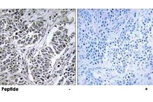 Immunohistochemistry analysis of paraffin-embedded human lung carcinoma tissue using ATP5D polyclonal antibody . (ATP5F1D anticorps)