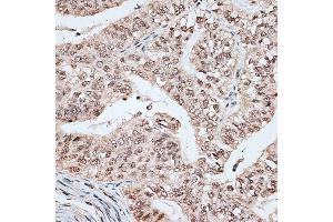Immunohistochemistry of paraffin-embedded human endometrium cancer using RBM17 antibody (ABIN6133103, ABIN6146765, ABIN6146766 and ABIN6220171) at dilution of 1:100 (40x lens). (RBM17 anticorps  (AA 1-240))