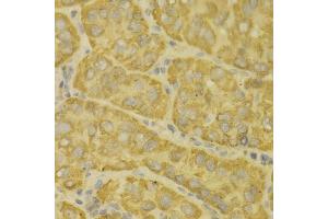 Immunohistochemistry of paraffin-embedded human liver cancer using MAOA antibody (ABIN5970633) at dilution of 1/100 (40x lens). (Monoamine Oxidase A anticorps)