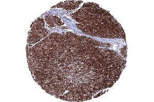 Squamous cell carcinoma of the esophagus showing a Cystatin A immunostaining of all tumor cells