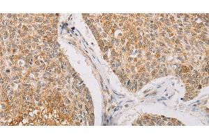 Immunohistochemistry of paraffin-embedded Human lung cancer tissue using STK40 Polyclonal Antibody at dilution 1:40 (STK40 anticorps)