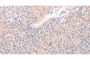 Immunohistochemistry of paraffin-embedded Human liver cancer tissue using ACO1 Polyclonal Antibody at dilution 1:50