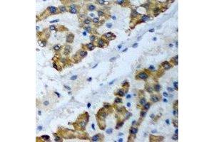 Immunohistochemical analysis of PSMF1 staining in human liver cancer formalin fixed paraffin embedded tissue section. (PSMF1 anticorps)