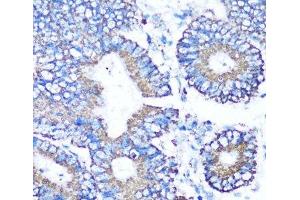 Immunohistochemistry of paraffin-embedded Human colon carcinoma using MMP16 Polyclonal Antibody at dilution of 1:100 (40x lens). (MMP16 anticorps)