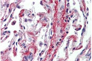 Human Lung (formalin-fixed, paraffin-embedded) stained with PODXL antibody ABIN462244 followed by biotinylated goat anti-rabbit IgG secondary antibody ABIN481713, alkaline phosphatase-streptavidin and chromogen.