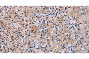 Immunohistochemistry of paraffin-embedded Human prostate cancer using SLC1A6 Polyclonal Antibody at dilution of 1:40 (SLC1A6 anticorps)