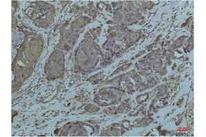 Immunohistochemistry (IHC) analysis of paraffin-embedded Human Breast Carcicnoma using GRP78/Bip Mouse Monoclonal Antibody diluted at 1:200.