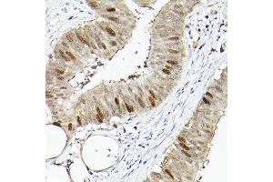 Immunohistochemistry of paraffin-embedded human colon carcinoma using RG Rabbit pAb (ABIN6127968, ABIN6146621, ABIN6220915 and ABIN6220916) at dilution of 1:50 (40x lens).