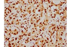 IHC image of ABIN7127541 diluted at 1:154 and staining in paraffin-embedded human liver cancer performed on a Leica BondTM system.