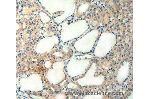 Immunohistochemistry of Human thyroid cancer using AGRN Polyclonal Antibody at dilution of 1:50 (AGRN anticorps)