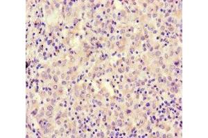 Immunohistochemistry of paraffin-embedded human lung cancer using ABIN7167721 at dilution of 1:100 (CoREST anticorps  (AA 394-482))