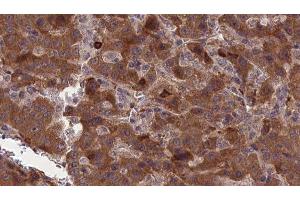 ABIN6277317 at 1/100 staining Human liver cancer tissue by IHC-P. (CNTF Receptor alpha anticorps  (Internal Region))