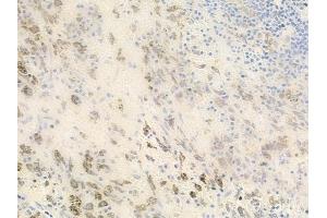 ABIN6262527 and ABIN6278482 at 1/100 staining human melanoma by IHC-P. (IL32 anticorps  (Internal Region))