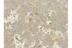 ABIN6264456 and ABIN6276899 at 1/100 staining human melanoma by IHC-P.