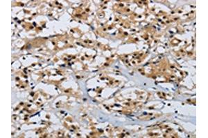 The image on the left is immunohistochemistry of paraffin-embedded Human thyroid cancer tissue using ABIN7190315(CMTM8 Antibody) at dilution 1/40, on the right is treated with synthetic peptide. (CMTM8 anticorps)