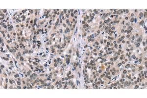 Immunohistochemistry of paraffin-embedded Human esophagus cancer tissue using ADNP Polyclonal Antibody at dilution 1:50 (ADNP anticorps)