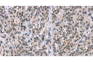 Immunohistochemistry of paraffin-embedded Human esophagus cancer tissue using ADNP Polyclonal Antibody at dilution 1:50