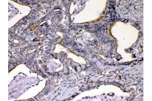 IHC testing of FFPE human intestinal cancer tissue with CCN3 antibody at 1ug/ml. (NOV anticorps  (AA 334-357))