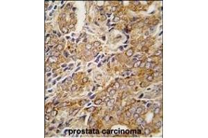 Formalin-fixed and paraffin-embedded human prostata carcinoma tissue reacted with TR antibody (C-term ) (ABIN392821 and ABIN2842253) , which was peroxidase-conjugated to the secondary antibody, followed by DAB staining. (TRPM8 anticorps  (C-Term))